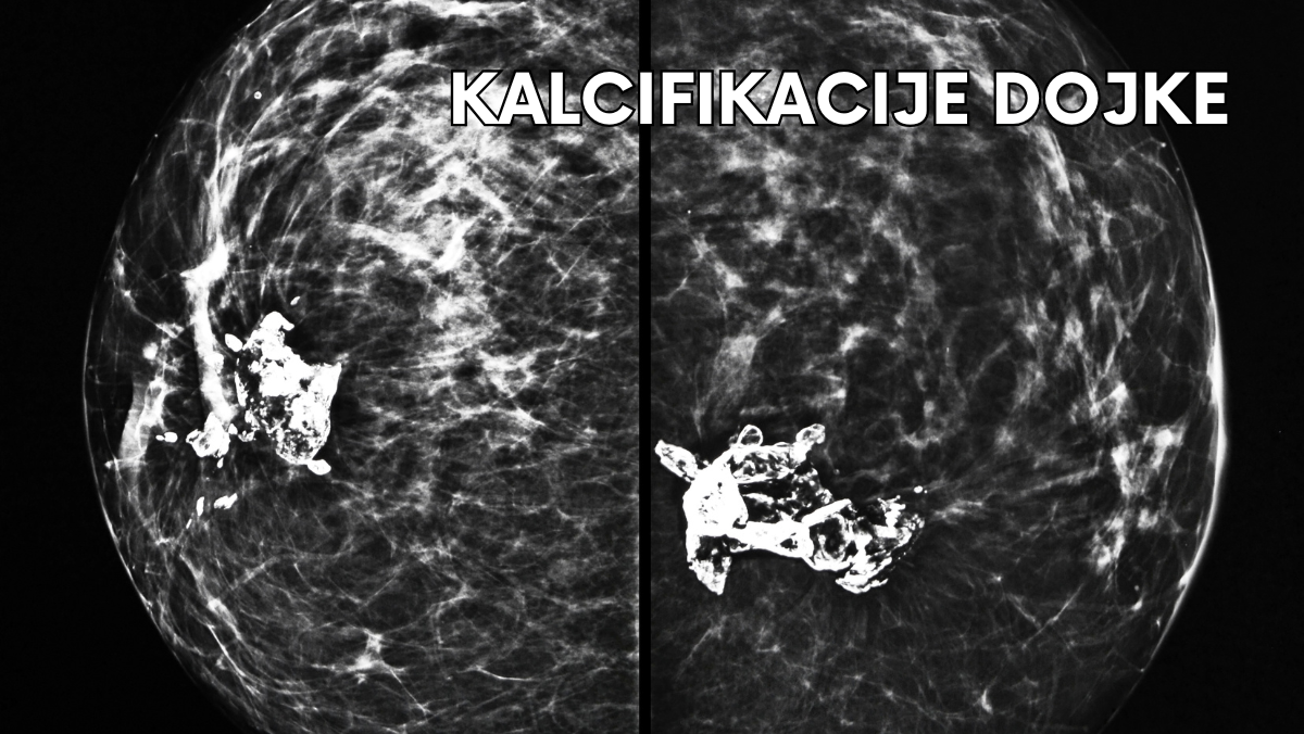 Kalcifikacije dojke
