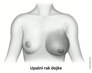 Upalni rak dojke