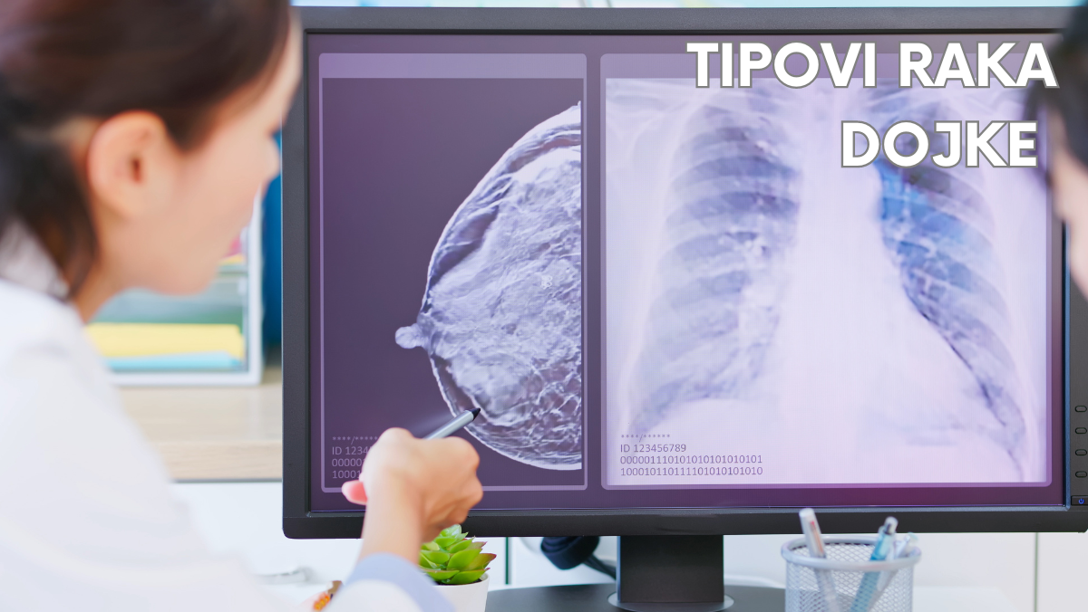 Tipovi raka dojke: Šta znači vaša dijagnoza