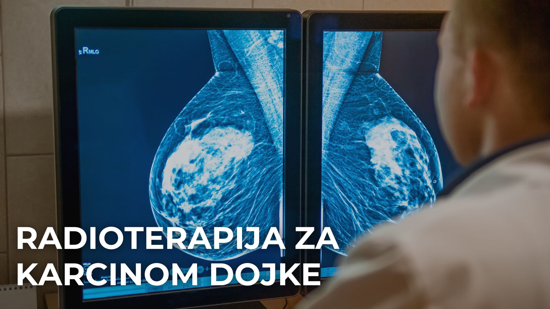 Radioterapija za karcinom dojke