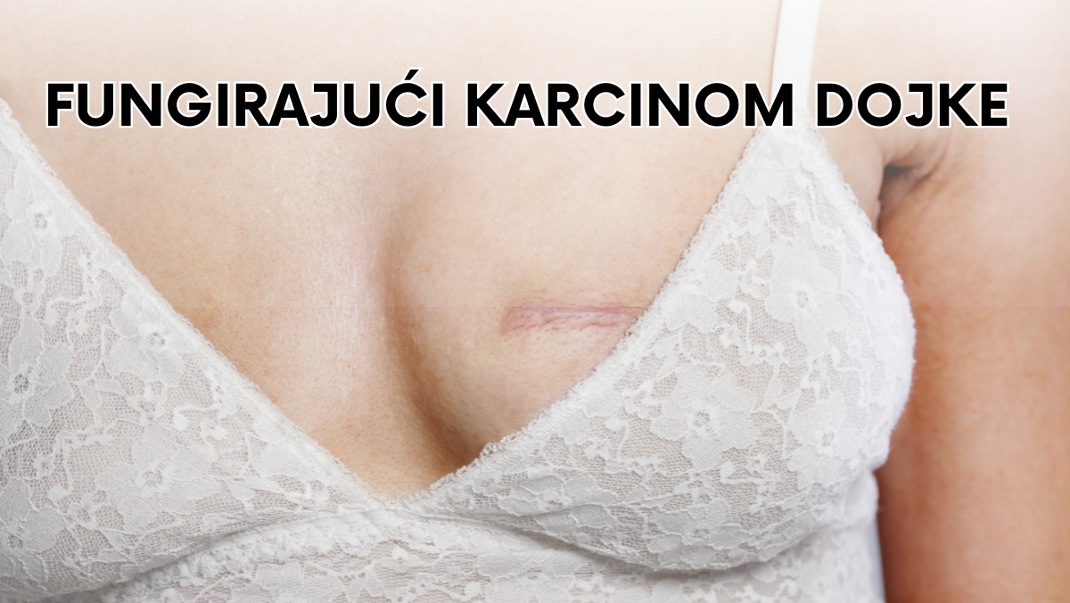 Fungirajući karcinom dojke