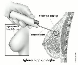 iglena biopsija dojke