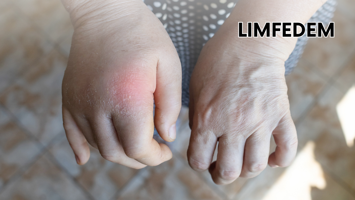 Limfedem